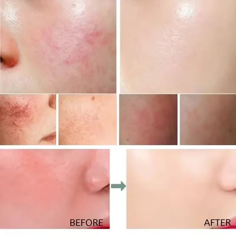 Yüz Kızarıklığı Onarıcı Krem H - Coenzyme Q10 Cream incelemesi ve fiyatı